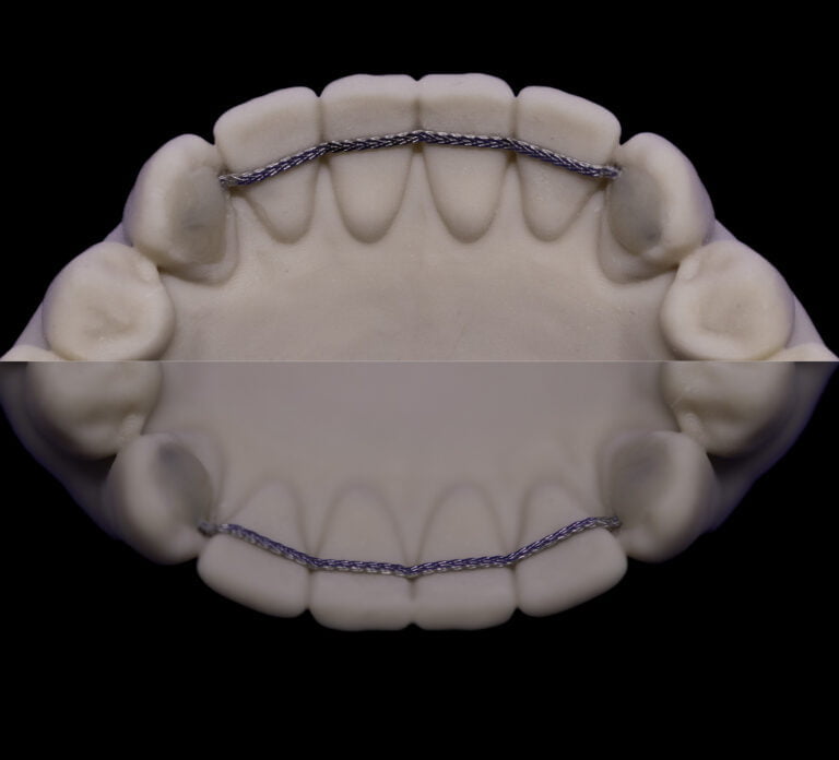 sculpture of a teeth model with a rear retainer on a reflective surface