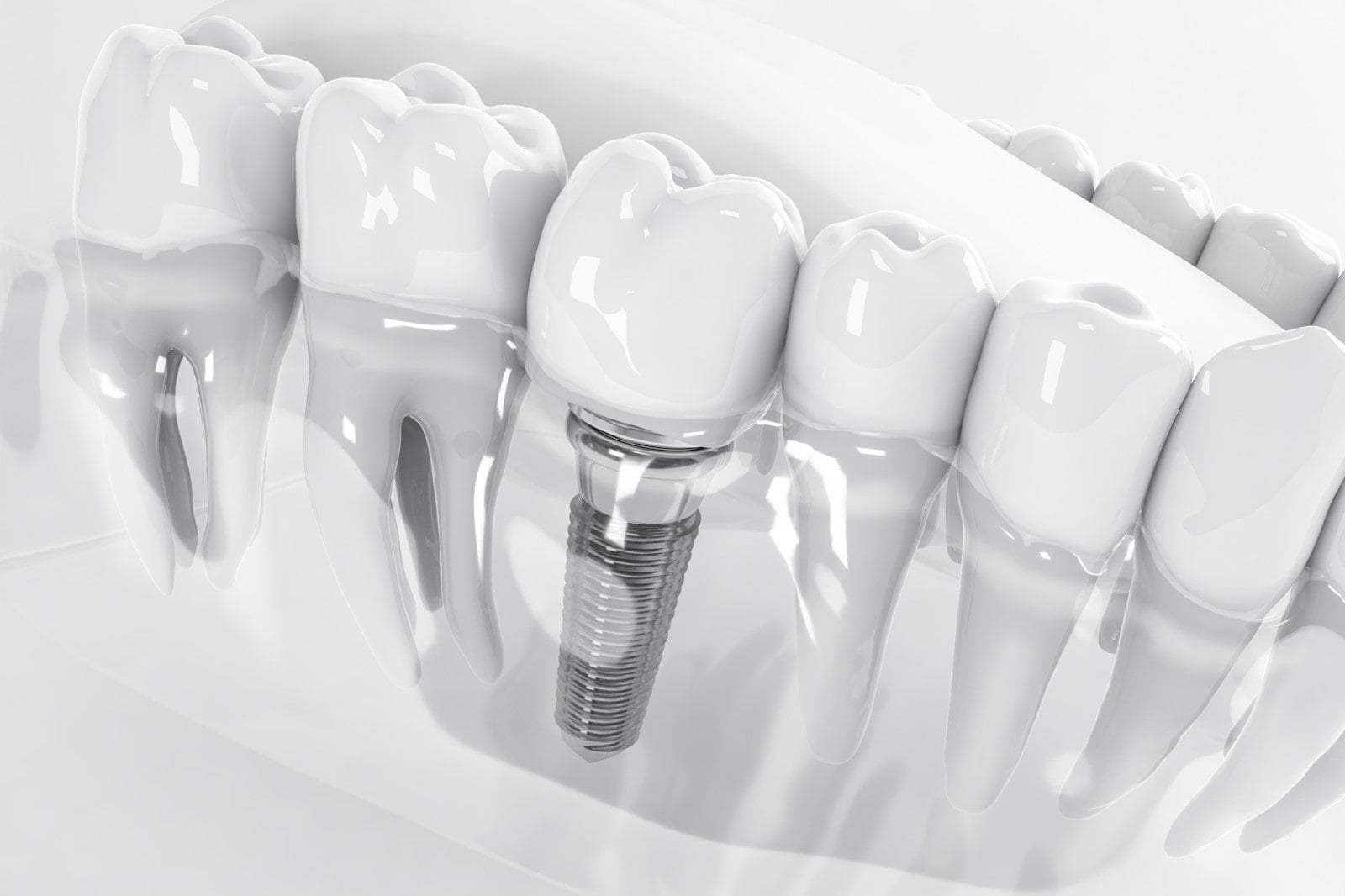 dental implant 3d model