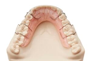 Full arch removable orthodontic device