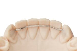 Fixed retainer wire lingual